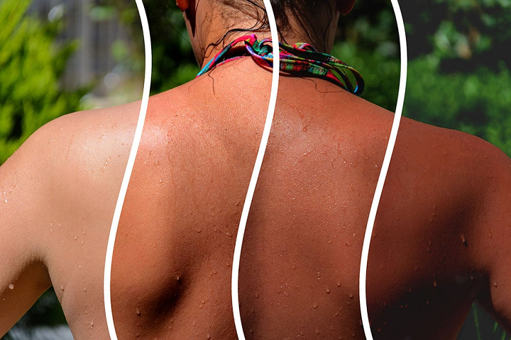 Image showing the back of a person with distinct tan lines illustrating the effect of sunscreen.